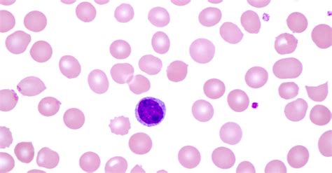 mbl scores|Monoclonal B.